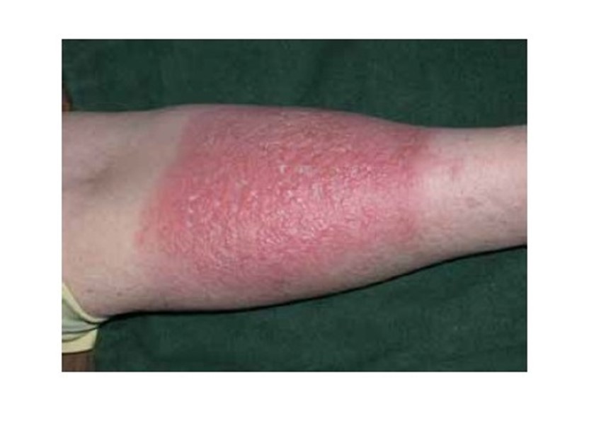 dermatitis aguda por uso de hipoclorito de sodio